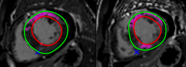 Risk stratification in HCM