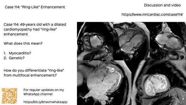 Case 114: "Ring-Like" Enhancement