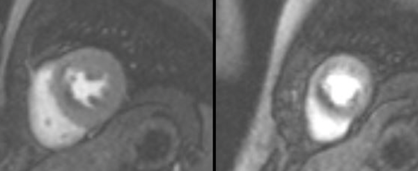 Stress CMR series: Case 1