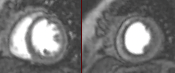 Stress CMR series: Case 4