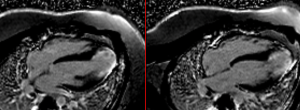 Apical HCM- Revisited