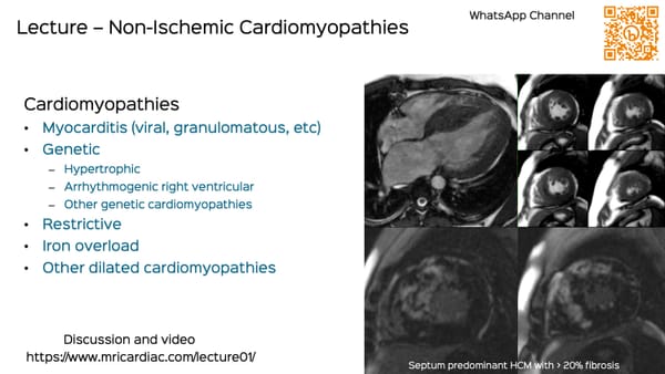 Lecture: Non-Ischemic Cardiomyopathies