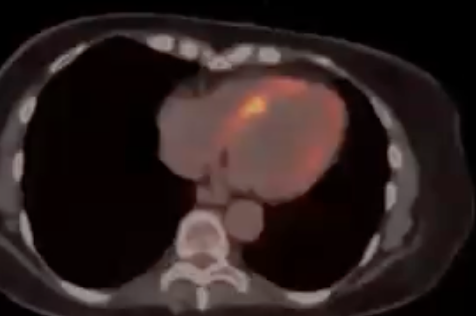 Cardiac Sarcoid