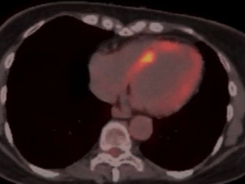 Cardiac sarcoid: A great Masquerader !