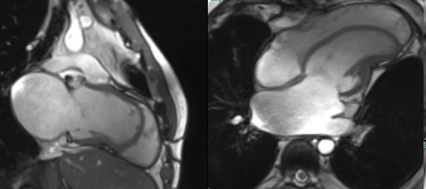 Isolated LV apical hypoplasia