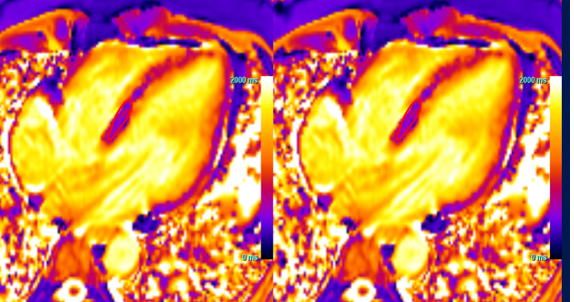 Systemic Hemochromatosis