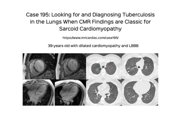 Case 195: Looking for and Diagnosing Tuberculosis in the Lungs When CMR Findings are Classic for Sarcoid Cardiomyopathy