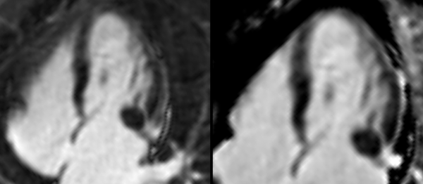 Cardiac Pseudotumor