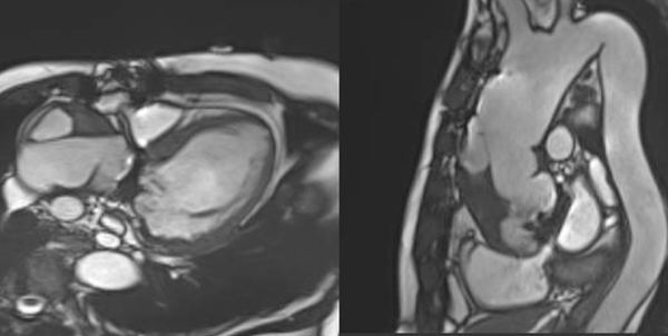No problem with prosthetic valve!