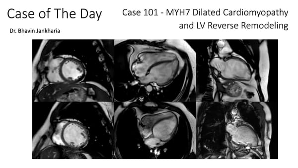 Case of the Day 101 - 2025 09 11 - MYH7 Dilated Cardiomyopathy and LV Reverse Remodeling