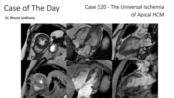 Case of the Day 120 - The Universal Ischemia of Apical HCM