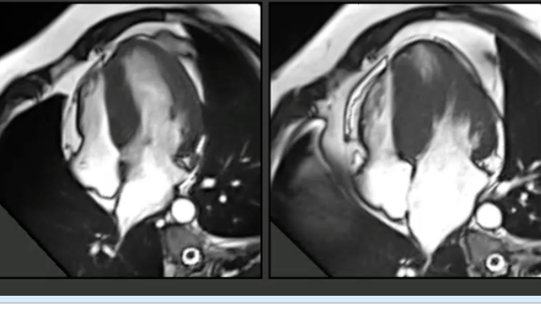 New CMR indication in HCM management.