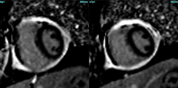 Thick shell around heart!