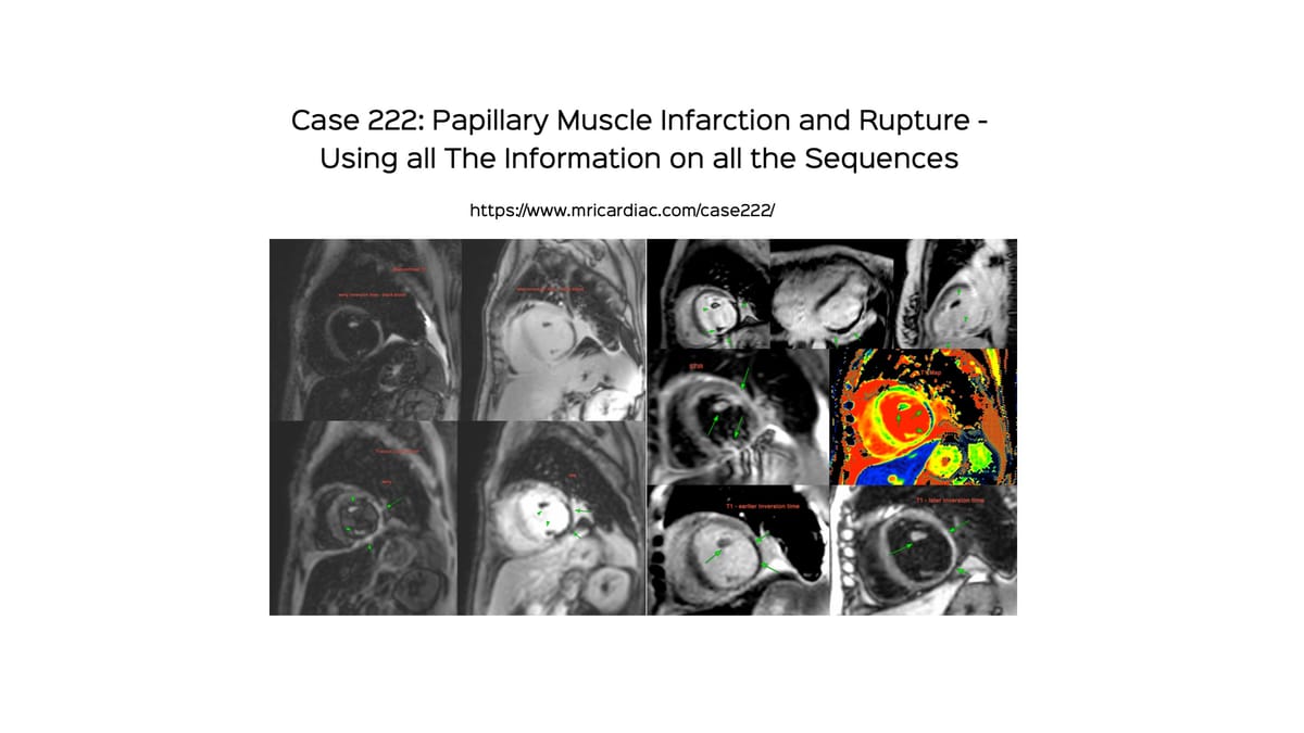 Case 226: Diagnosing Left Ventricular Free Wall Rupture without Aneurysm