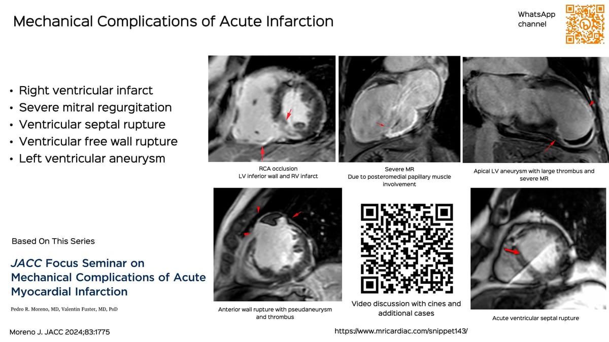 Case 226: Diagnosing Left Ventricular Free Wall Rupture without Aneurysm